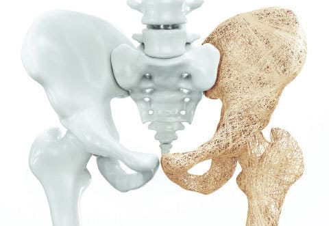 ST_Osteoporosis_Grid - Smart-Fill Pelvis Skeleton